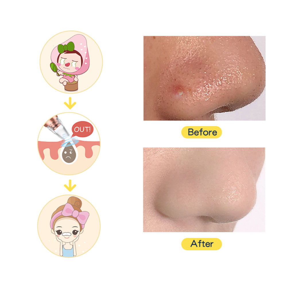 6 Suction Heads Blackhead Whitehead Extractor Remover Device Suction Tool